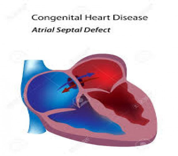 Atriyal Septal Defekt 570x500 1