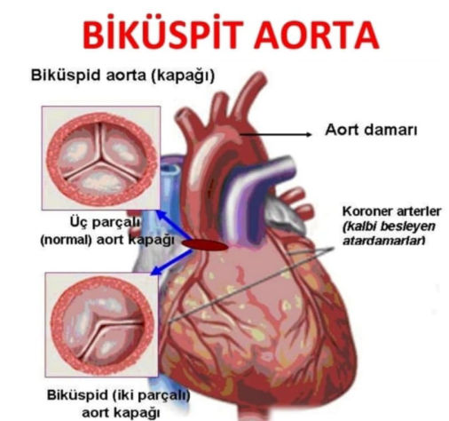 services-01 Bikuspit Aorta 506x474 1